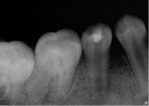 image8-300x213 Pre-Operative – #29 – necrotic pulp in an undeveloped root