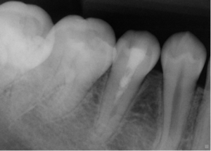 image9-300x214 Post-Operative – #29 – 20 month recall showing root formation